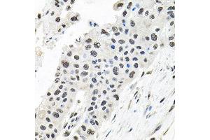 Immunohistochemistry of paraffin-embedded human lung cancer using CDCA8 antibody at dilution of 1:100 (x40 lens). (CDCA8 Antikörper)