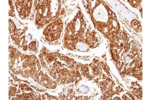 IHC-P Image Immunohistochemical analysis of paraffin-embedded human tyroid cancer, using PPP2R5D, antibody at 1:100 dilution. (PPP2R5D Antikörper  (C-Term))