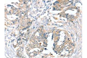 The image on the left is immunohistochemistry of paraffin-embedded Human cervical cancer tissue using ABIN7192539(SLC9A9 Antibody) at dilution 1/45, on the right is treated with synthetic peptide. (SLC9A9 Antikörper)