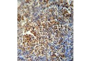Immunohistochemistry analysis in formalin fixed and paraffin embedded human lung carcinoma reacted with MAF1 Antibody (Center) followed which was peroxidase conjugated to the secondary antibody and followed by DAB staining. (MAF1 Antikörper  (Middle Region))