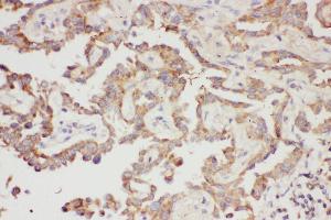 Anti-Galectin 3 Picoband antibody,  IHC(P): Human Lung Cancer Tissue (Galectin 3 Antikörper  (AA 139-250))