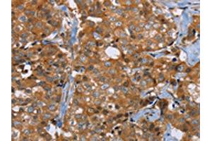The image on the left is immunohistochemistry of paraffin-embedded Human breast cancer tissue using ABIN7191755(P2RY1 Antibody) at dilution 1/40, on the right is treated with synthetic peptide. (P2RY1 Antikörper)