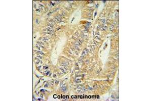 HPGD Antibody IHC analysis in formalin fixed and paraffin embedded human colon carcinoma followed by peroxidase conjugation of the secondary antibody and DAB staining. (HPGD Antikörper  (C-Term))
