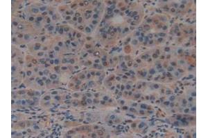 IHC-P analysis of Human Liver Cancer Tissue, with DAB staining. (PTF1A Antikörper  (AA 177-328))