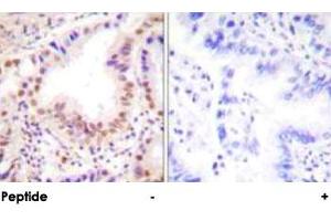 Immunohistochemical analysis of paraffin-embedded human lung carcinoma tissue using ETS1 polyclonal antibody .