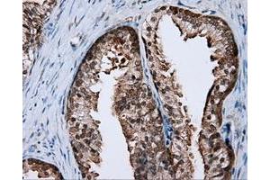 Immunohistochemical staining of paraffin-embedded Carcinoma of liver tissue using anti-RALBP1 mouse monoclonal antibody. (RALBP1 Antikörper)