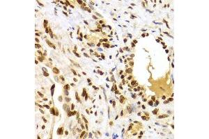 Immunohistochemistry of paraffin-embedded human adenomyosis using HMGB1 Antibody. (HMGB1 Antikörper  (AA 100-200))