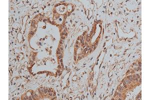 ABIN6268858 at 1/50 staining human colon cancer tissue sections by IHC-P. (MCL-1 Antikörper  (Internal Region))