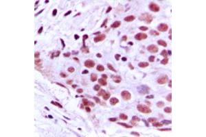 Immunohistochemical analysis of MCM2 staining in human breast cancer formalin fixed paraffin embedded tissue section. (MCM2 Antikörper  (N-Term))