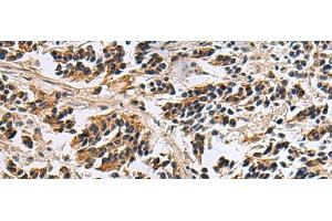 Immunohistochemistry of paraffin-embedded Human breast cancer tissue using DIAPH2 Polyclonal Antibody at dilution of 1:55(x200) (DIAPH2 Antikörper)