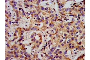 IHC image of ABIN7153315 diluted at 1:300 and staining in paraffin-embedded human liver cancer performed on a Leica BondTM system. (G Protein-Coupled Receptor 1 Antikörper  (AA 308-355))