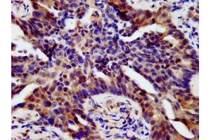 IHC image of ABIN7155739 diluted at 1:500 and staining in paraffin-embedded human lung cancer performed on a Leica BondTM system. (HOXB4 Antikörper  (AA 88-166))