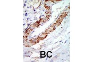 Formalin-fixed and paraffin-embedded human cancer tissue reacted with the primary antibody, which was peroxidase-conjugated to the secondary antibody, followed by DAB staining. (MAP3K8 Antikörper  (C-Term))