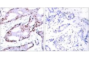 Immunohistochemistry analysis of paraffin-embedded human breast carcinoma tissue, using c-Jun (Ab-73) Antibody. (C-JUN Antikörper  (AA 40-89))