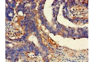 Immunohistochemistry of paraffin-embedded human colon cancer using ABIN7158800 at dilution of 1:100 (SCARB2 Antikörper  (AA 47-128))