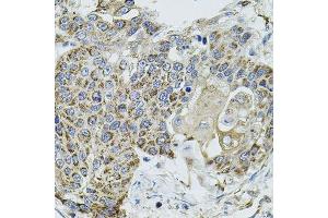 Immunohistochemistry of paraffin-embedded human lung cancer using VEPH1 antibody. (VEPH1 Antikörper  (AA 448-547))