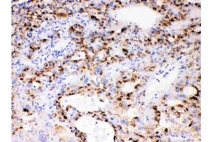 CYP3A4 was detected in paraffin-embedded sections of human liver cancer tissues using rabbit anti- CYP3A4 Antigen Affinity purified polyclonal antibody (Catalog # ) at 1 µg/mL.
