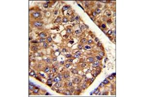 AP17615PU-N P4HB antibody staining of Formalin-Fixed and paraffin-Embedded Human hepatocarcinoma using peroxidase-conjugated to the secondary antibody, followed by DAB staining. (P4HB Antikörper  (C-Term))