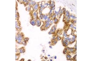 Immunohistochemistry of paraffin-embedded human liver cancer using GLUD2 antibody. (GLUD2 Antikörper  (AA 319-558))