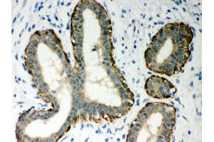 Anti- MASPIN Picoband antibody, IHC(P) IHC(P): Human Mammary Cancer Tissue