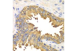 Immunohistochemistry of paraffin-embedded human prostate using DDX58 antibody (ABIN5970201) at dilution of 1/100 (40x lens). (DDX58 Antikörper)