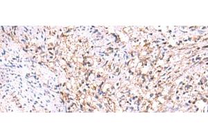 Immunohistochemistry of paraffin-embedded Human cervical cancer tissue using MANSC1 Polyclonal Antibody at dilution of 1:105(x200) (MANSC1 Antikörper)