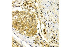 Immunohistochemistry of paraffin-embedded human esophageal cancer using CDK7 antibody (ABIN1871743) at dilution of 1:200 (40x lens). (CDK7 Antikörper)