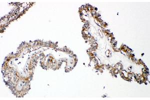 Anti-Parathyroid Hormone Receptor 1 antibody, IHC(P) IHC(P): Human Thyroid Cancer Tissue