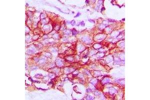 Immunohistochemical analysis of IFNGR1 staining in human breast cancer formalin fixed paraffin embedded tissue section. (IFNGR1 Antikörper  (C-Term))