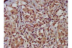 IHC image of ABIN7149946 diluted at 1:500 and staining in paraffin-embedded human liver cancer performed on a Leica BondTM system. (TFB1M Antikörper  (AA 59-194))