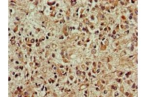 Immunohistochemistry of paraffin-embedded human glioma using ABIN7149696 at dilution of 1:100 (DCK Antikörper  (AA 1-79))