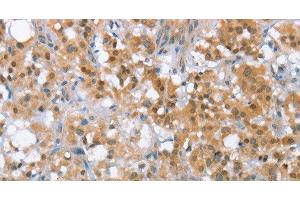 Immunohistochemistry of paraffin-embedded Human thyroid cancer tissue using MLH1 Polyclonal Antibody at dilution 1:65 (MLH1 Antikörper)