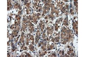 Immunohistochemical staining of paraffin-embedded Carcinoma of liver tissue using anti-MSMB mouse monoclonal antibody. (MSMB Antikörper)