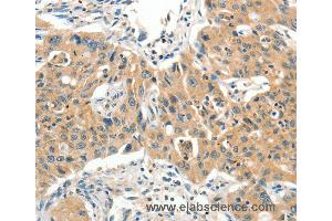 Immunohistochemistry of Human lung cancer using SLC11A2 Polyclonal Antibody at dilution of 1:65