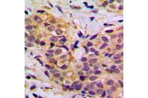 Immunohistochemical analysis of MRPL11 staining in human breast cancer formalin fixed paraffin embedded tissue section. (MRPL11 Antikörper  (Center))