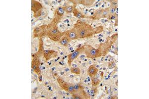 Formalin-fixed and paraffin-embedded human hepatocarcinoma reacted with GCG Antibody (N-term), which was peroxidase-conjugated to the secondary antibody, followed by DAB staining. (Glucagon Antikörper  (N-Term))
