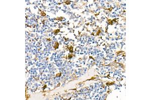 Immunohistochemistry of paraffin-embedded Human Hodgkin lymphoma using Fascin/FSCN1 antibody (ABIN7267142) at dilution of 1:100 (40x lens). (Fascin Antikörper)