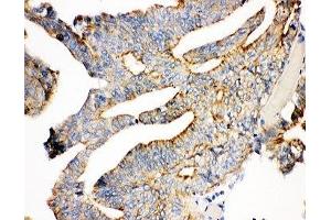 IHC-P: Plakoglobin antibody testing of human intestine cancer tissue (JUP Antikörper  (AA 556-745))