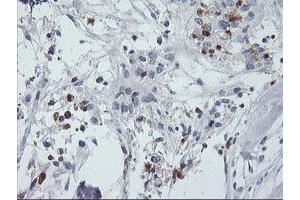 Immunohistochemical staining of paraffin-embedded Adenocarcinoma of Human breast tissue using anti-SDS mouse monoclonal antibody. (serine Dehydratase Antikörper)