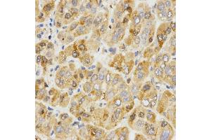 Immunohistochemistry of paraffin-embedded human liver cancer using TPM2 antibody (ABIN5971583) at dilution of 1/200 (40x lens). (TPM2 Antikörper)