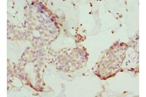 Immunohistochemistry of paraffin-embedded human breast cancer using ABIN7173557 at dilution of 1:100 (Tropomodulin 4 Antikörper  (AA 1-345))