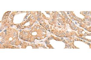 Immunohistochemistry of paraffin-embedded Human thyroid cancer tissue using DEF8 Polyclonal Antibody at dilution of 1:25(x200)