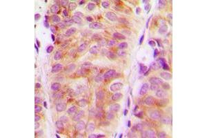 Immunohistochemical analysis of ARHGEF10 staining in human breast cancer formalin fixed paraffin embedded tissue section. (ARHGEF10 Antikörper  (Center))