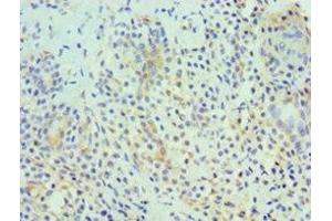 Immunohistochemistry of paraffin-embedded human breast cancer using ABIN7155322 at dilution of 1:100
