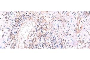 Immunohistochemistry of paraffin-embedded Human cervical cancer tissue using MRPS24 Polyclonal Antibody at dilution of 1:90(x200) (MRPS24 Antikörper)