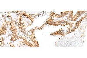 Immunohistochemistry of paraffin-embedded Human thyroid cancer tissue using ENAH Polyclonal Antibody at dilution of 1:60(x200) (ENAH Antikörper)