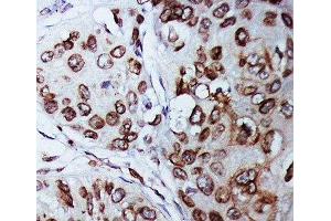 IHC-P: Lamin B1 antibody testing of human breast cancer tissue
