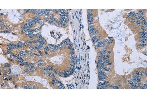 Immunohistochemistry of paraffin-embedded Human colon cancer using HYAL3 Polyclonal Antibody at dilution of 1:40 (HYAL3 Antikörper)