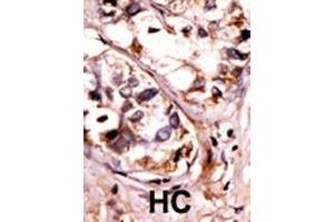 Formalin-fixed and paraffin-embedded human cancer tissue reacted with the primary antibody, which was peroxidase-conjugated to the secondary antibody, followed by AEC staining. (SYK Antikörper  (pTyr525, pTyr526))