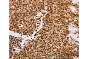 Immunohistochemistry of Human lung cancer using THOC7 Polyclonal Antibody at dilution of 1:30 (THOC7 Antikörper)